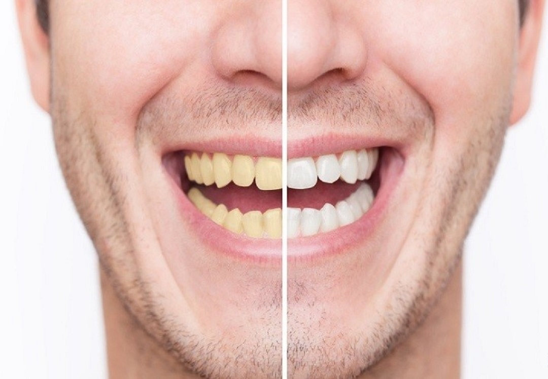 سفید کردن و از بین بردن زردی دندان