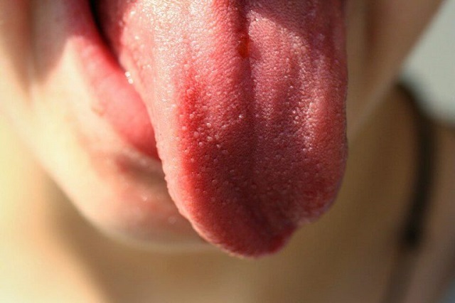 رنگ زبان قرمز روشن برای تشخیص بیماری