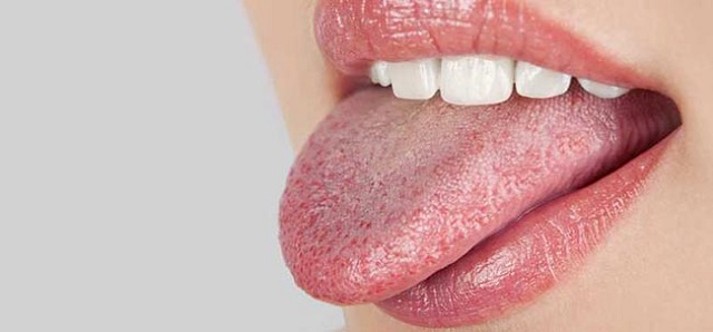رنگ زبان پریده سفید متمایل به زرد