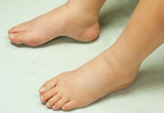 تورم پاها از علائم سکته قلبی مردان و زنان 