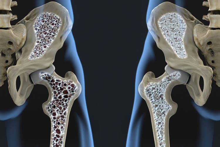 عوامل موثر بر پوکی استخوان در زنان و مردان؛پیشگیری و درمان پوکی استخوان با تغذیه