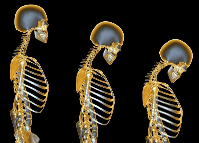 عوامل موثر بر پوکی استخوان؛ پیشگیری، تشخیص و درمان پوکی استخوان با تغذیه