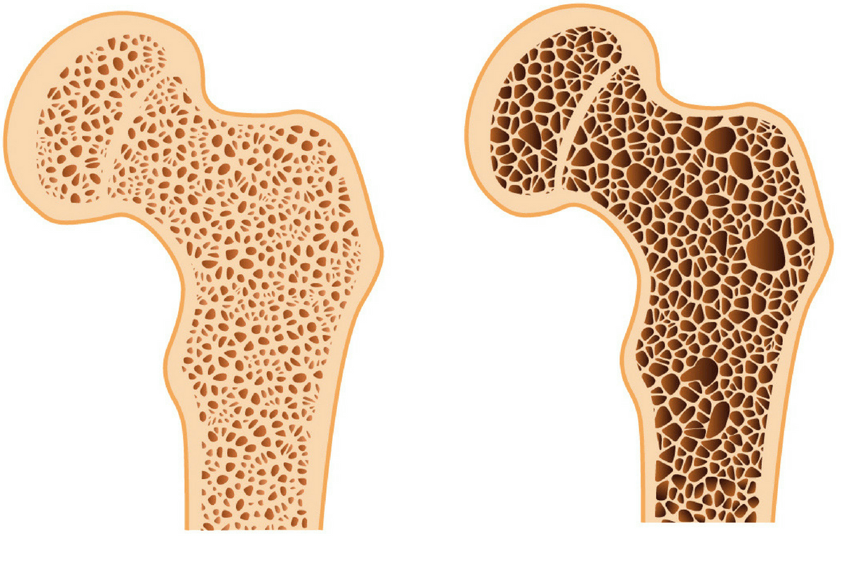 عوامل موثر بر پوکی استخوان در زنان و مردان؛ پیشگیری و درمان پوکی استخوان با تغذیه