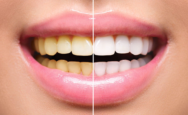 همه چیز درباره سفید کردن و بلیچینگ دندان؛ عوارض و فواید انواع بلیچینگ