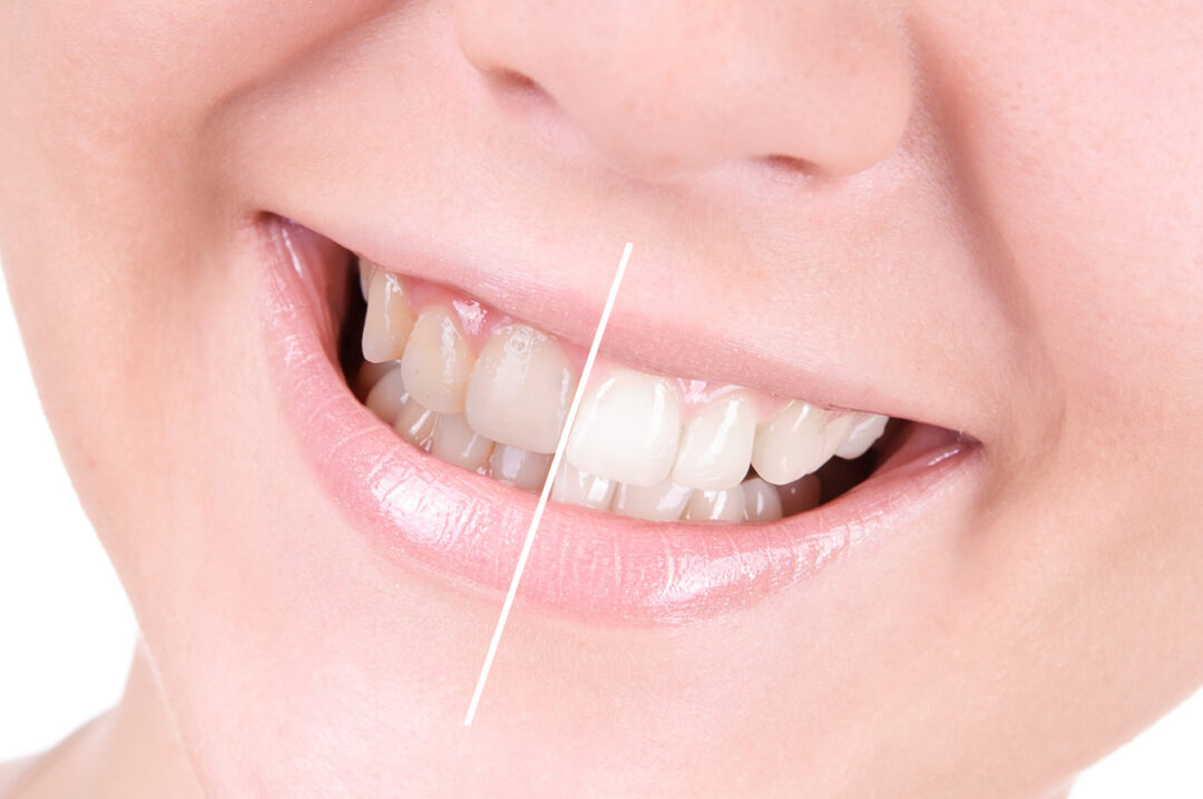 روش های از بین بردن زردی دندان