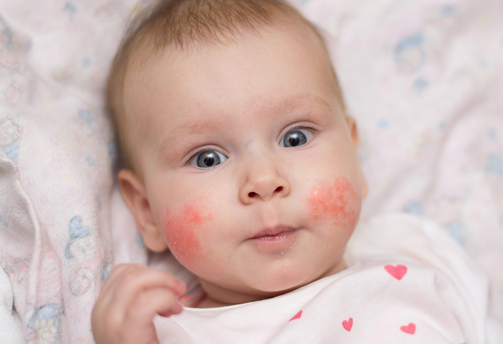 علت جوش زدن صورت و بدن نوزاد؛ روش‌های تشخیص و درمان آن