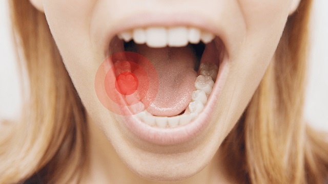 استفاده از آب نمک برای درمان دندان درد