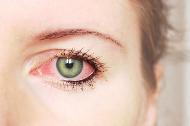 عوارض و خطرات لنزهای رنگی آرایشی برای سلامت چشم و بینایی 