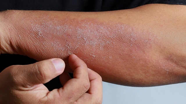 عفونت پوست چیست؟