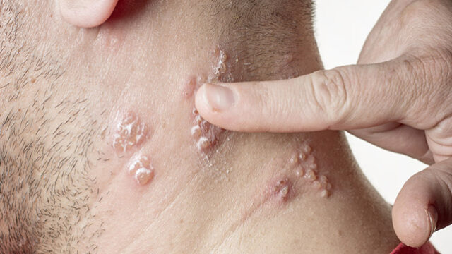 شناخت عفونت باکتریایی پوست و درمان آن