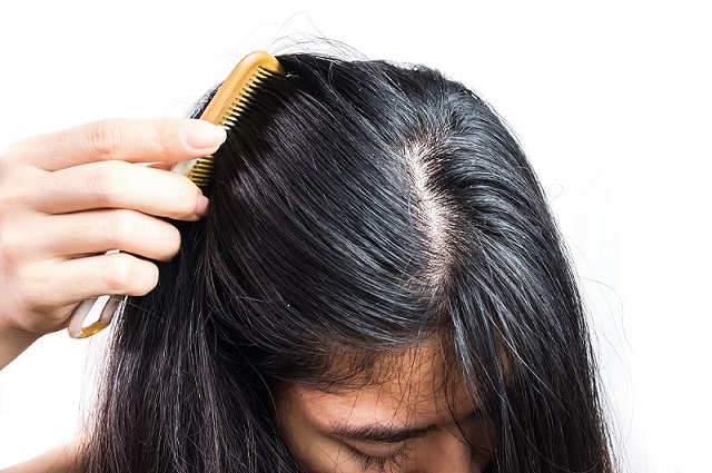 شانه زدن موها را برای درمان شوره سر فراموش نکنید