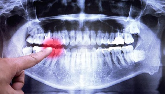 جراحی کرونوپلاستی بری درمان بروکسیم یا دندان قروچه