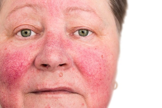 روزاسه یا التهاب قرمزی پوست از بیماری‌های رایج پوستی