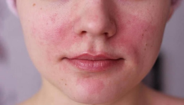 نقش روغن‌های پاک‌کننده در درمان التهاب قرمزی پوست