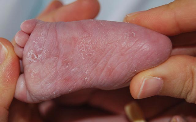 انواع بیماری لوپوس؛ لوپوس نوزادی چیست؟