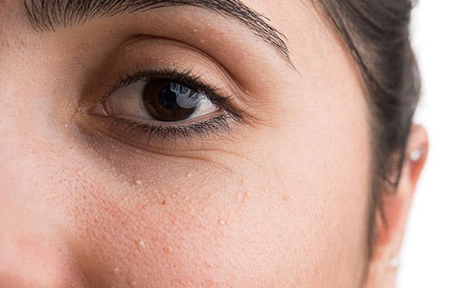 روش های درمان میلیا زیر چشم و صورت