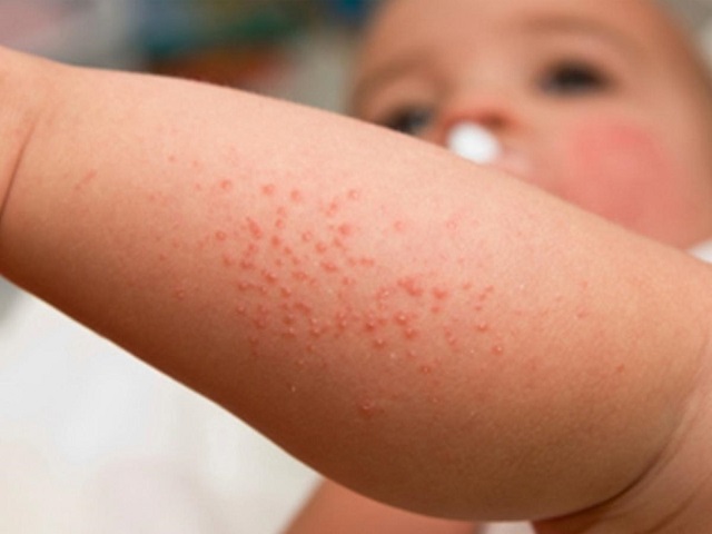 عرق سوز شدن رایج ترین حساسیت پوستی نوزادان
