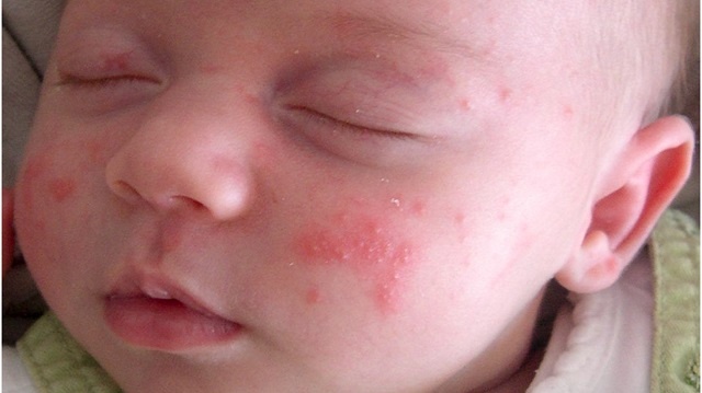 سرخک یک بیماری پوستی رایج در نوزادان
