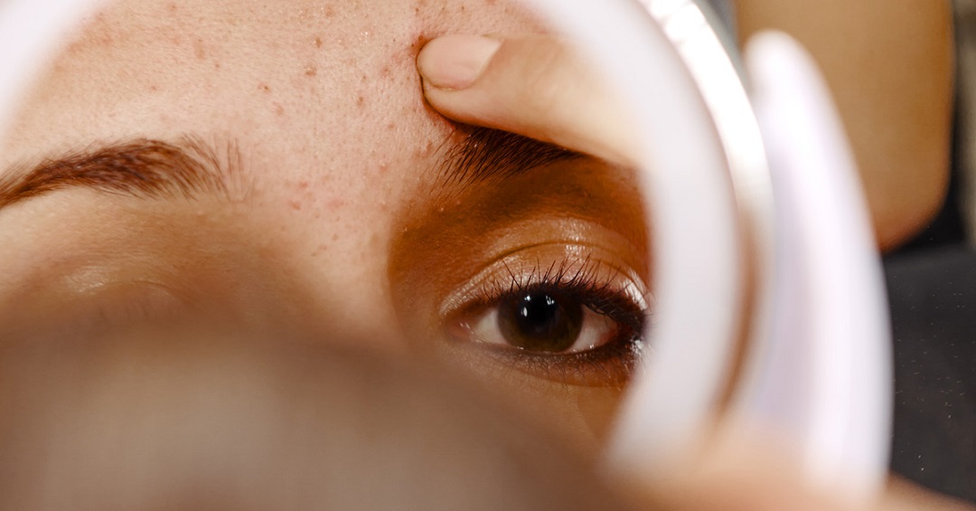درمان سریع جوش زیر پوستی صورت و پیشانی و چانه و بینی