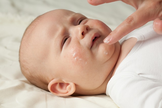 اگزما از رایج ترین مشکلات و بیماری های پوستی نوزادان