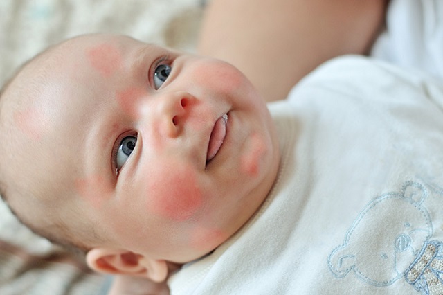 سندرم گونه سرخ، یک بیماری رایج پوستی در نوزادان