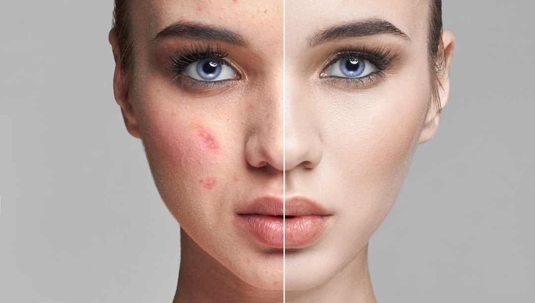 درمان سریع لک های پوستی