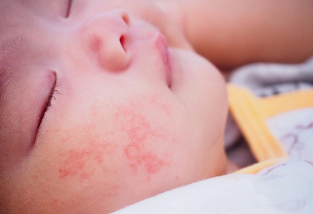 آلرژی غذایی عاملی مهم در حساسیت پوستی نوزادان