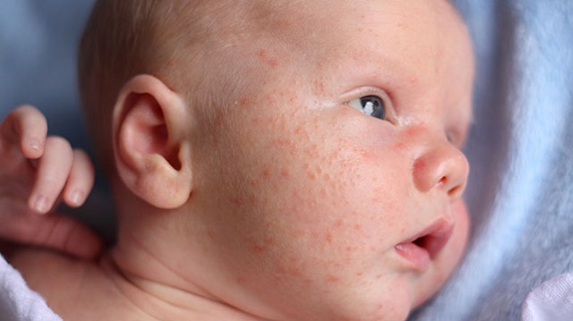 درماتیت تماسی، از رایج ترین انواع حساسیت پوستی در کودکان