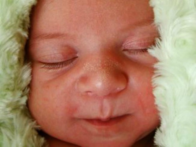 میلیا، یک بیماری پوستی رایج در نوزادان
