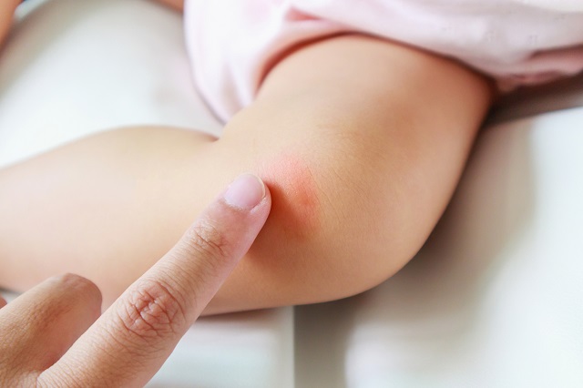 پیچک سمی، از انواع حساسیت پوستی در کودکان