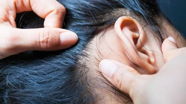 برداشتن تخم شپش با دست