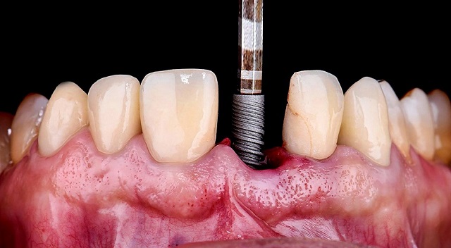 انواع ایمپلنت دندان