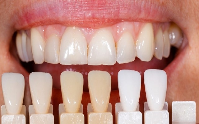 تفاوت کامپوزیت و انواع لمینت دندان