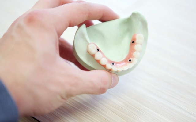 پوسیدگی دندان چه زمانی اتفاق می افتد؟