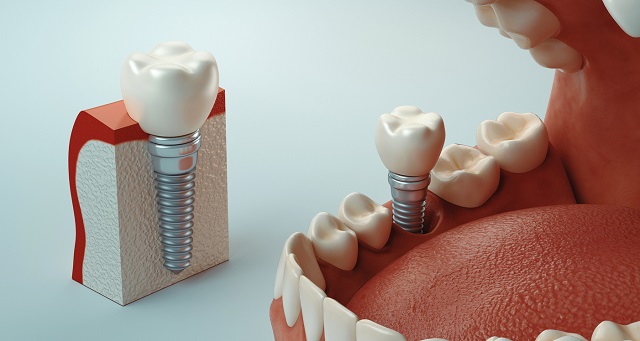 مراقبت های قبل و بعد از ایمپلنت دندان