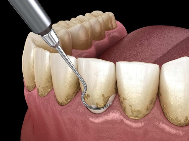 علت ایجاد جرم دندان