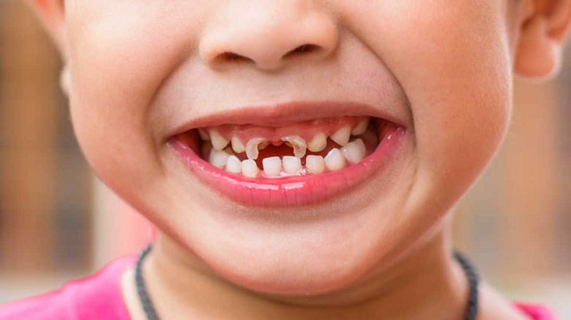 پوسیدگی دندان در کودکان چیست؟