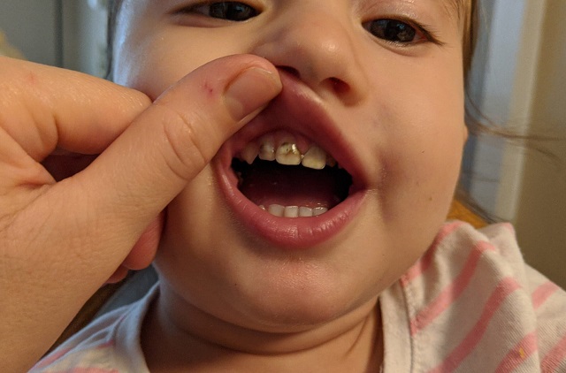 علائم پوسیدگی دندان کودک