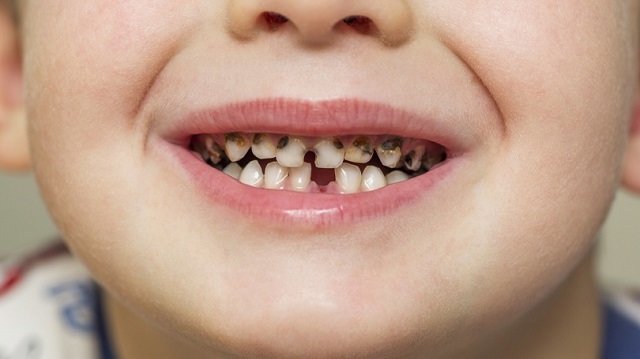 کدام کودکان بیشتر در معرض پوسیدگی دندان قرار دارند؟