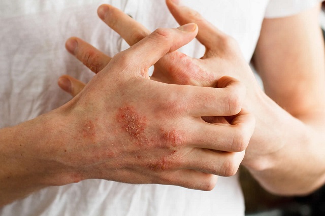 علائم آلرژی پوستی