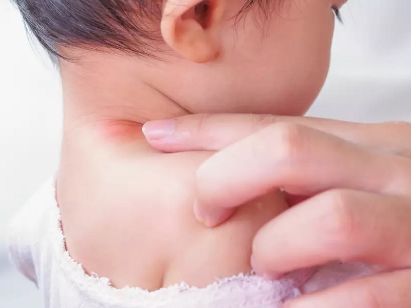 عرق سوز شدن گردن نوزاد | 15 روش پیشگیری و درمان سریع