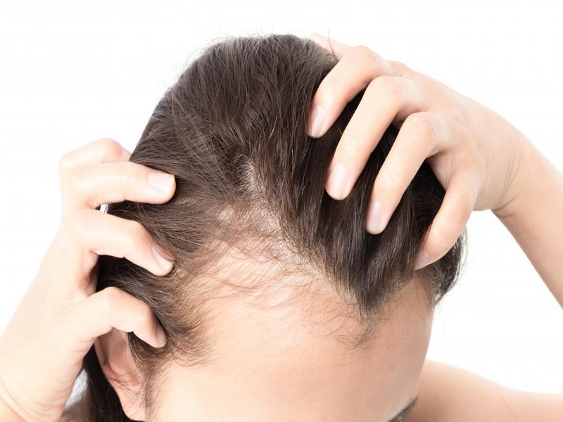 انواع ریزش مو و طاسی در زنان | علت، راه‌ های درمان و پیشگیری