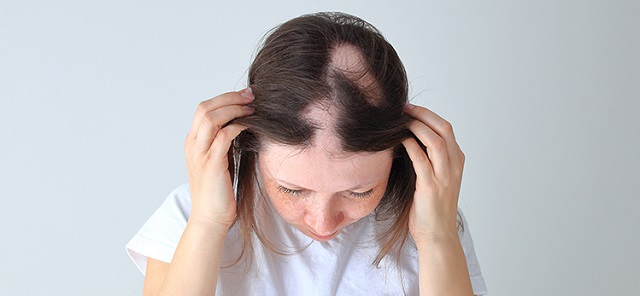 انواع ریزش مو چیست؟
