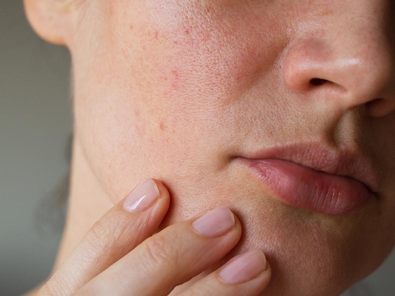 15 روش درمان کدری و تیرگی پوست صورت در خانه + 8 علت آن