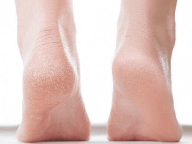 کاربرد شامپو بچه برای نرم شدن پوست پاها و رفع خشکی آن‌ها