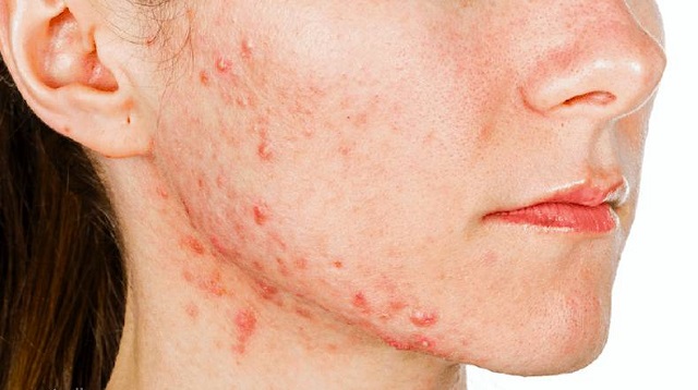 علائم شایع تنبلی تخمدان (PCOS) علائم شایع تنبلی تخمدان (PCOS)